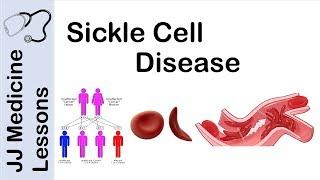 Sickle Cell Disease | Pathophysiology, Symptoms and Treatment