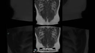 OPTIMISING HASTE SEQUENCE # MRI