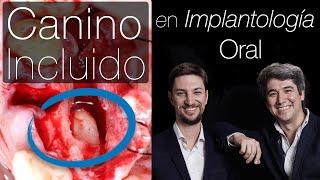  Manejo Canino incluido con Implante Dental Inmediato + Regeneración - Formación en Implantología