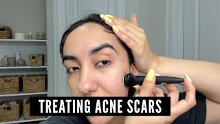 Best At Home Microneedling Tool For Acne Scars!