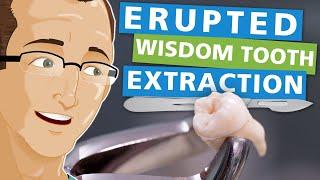 Erupted Wisdom Tooth Extraction