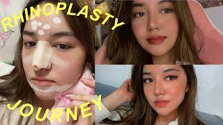 MY RHINOPLASTY JOURNEY (2 WEEKS POST-OP) | Andrea Angeles