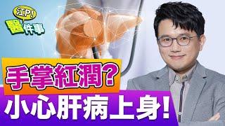 肝臟出問題！４大症狀小心肝病上身！肝掌 蜘蛛痣 黃疸 怎麼看？【江P醫件事#76】