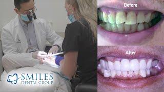 Cosmetic Smile Enhancement Procedures (Pre Covid)