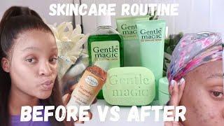 #skincareroutine|| Gentle magic products||Before Vs after #southafricanyoutuber