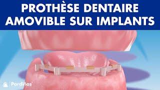 Prothèse dentaire amovible sur implants ©