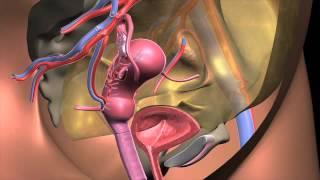 Uterus Transplant Animation Recipient