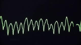 Cardiac arrest rhythms, VF, VT, Asystole and PEA