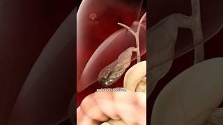 Gallbladder removal surgery - Open Cholecystectomy #shorts #gallbladder  - creativelearning3d