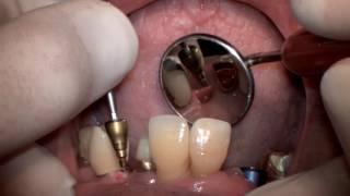 Prosthodontics Video: Implant retained