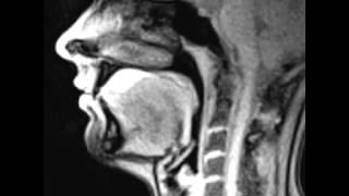 Real time MRI   Swallowing Pineapple Juice