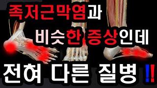 족저근막염에 대한 효과적인 최근치료법  발통증환자  필수영상, 족저근막염 진단을 받은환자의 상당수가 다른 질병이 원인이다!! 족근관 증후군