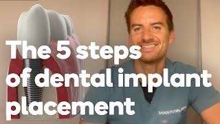 The 5 Steps of getting a dental implant