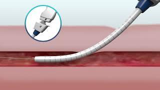 MANTA Vascular Closure Device Overview