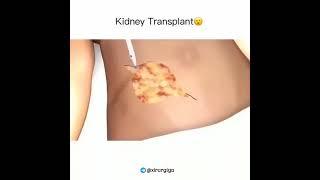 Kidney transplantation  |  신장 이식