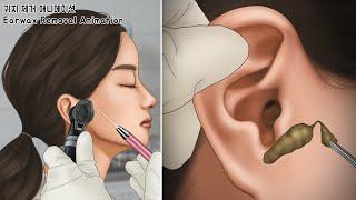 ASMR Oddly Satisfying Massive Earwax Removal | Ear cleaning