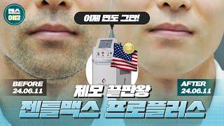 남자 제모 끝판왕! 젠틀맥스 프로 플러스 소개합니다!