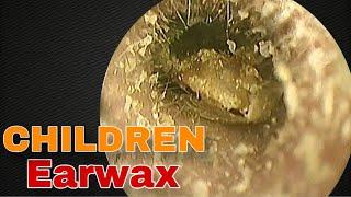 Remove Earwax for Children | Doctor Anh