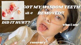 I GOT ALL 4 WISDOM TEETH REMOVED!!!(the truth) pre care, what I eat, recovery, and more