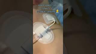 Правильное стояние дренажа | Визуальное представление #здоровье #нефростома #доктор #важно #short