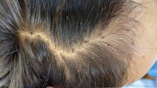 Picking out a lot of lice from long hair - Getting out lice from black hair