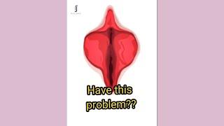 Labiaplasty: How it is done