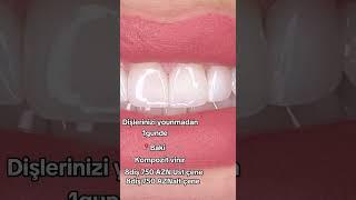 #veneers #composite #kompozit #vinirkompozit #ips