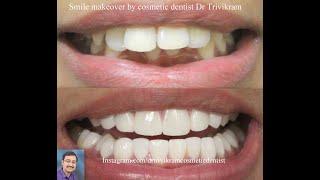 smile makeover