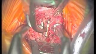 Surgical technique for revision surgery of cervical artificial disc replacements