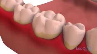 Dental plaque - Lapointe dental centres