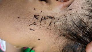 Remove hundred lice from short hair - Getting out all of big lice from his head