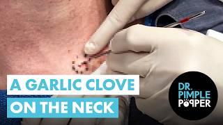 A Garlic Clove on the Neck