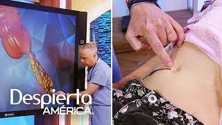 Apendicitis: causas, síntomas y cómo detectarla fácilmente | Dr. Juan