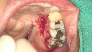 Hybrid Connective Tissue + Epithelial Palatal graft for the increase of volume and keratinised zone.