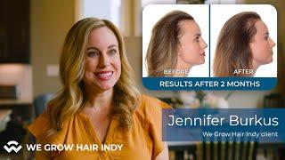 Jen's Hair Growth after Stress Related Hair Loss - Proven Hair Loss Treatments at We Grow Hair Indy