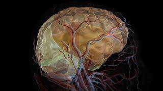 Stroke vs. Aneurysm: Different Symptoms, Treatments