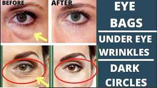 FACE YOGA FOR EYE BAGS, EYE WRINKLES, DARK CIRCLES | FACE MASSAGE for EYE BAGS | fix DROOPY EYELIDS