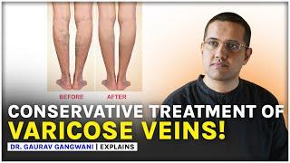 Varicose Veins Treatment Without Any Surgery || Dr. Gaurav Gangwani (Interventional Radiologist)