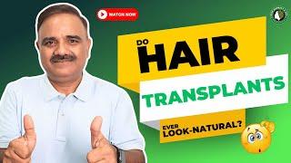 Do Hair Transplants Ever Look Natural?