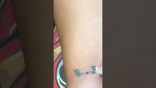 #tattooremover Super picosecond combined with dot matrix tattoo removal has the best effect