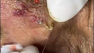 Massive Blackheads Removal #6