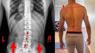Left AIC or Opposite  ? Left Pelvic Tilt – groin, back, and neck pain RESOLVED