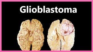 Glioblastoma Multiforme – Symptoms, Diagnosis and Treatment 