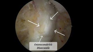 Osteocondrita Disecanta / Osteochondritis Dissecans - Dr. AHMAD ALQADI