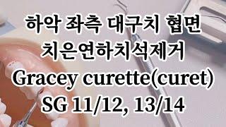 하악 좌측 대구치 협면 치은연하치석제거 gracey curette(curet) 그레이시 큐렛 SG 11/12, 13/14