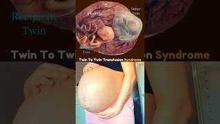 Twin to Twin Transfusion Syndrome  #twin #tts #share #fyp
