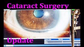 Cataract Surgery Update - Left Eye (4K)