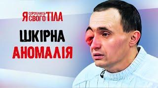 С рождения страдает от генетической болезни – Я соромлюсь свого тіла | МЕДИЦИНА