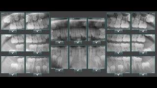 X-era Dental Cone Beam Machine FMX Clipping Video 2 0