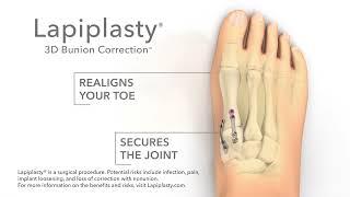 Lapiplasty - Outside